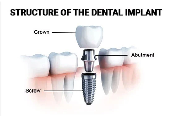 Structure of the Dental Implant